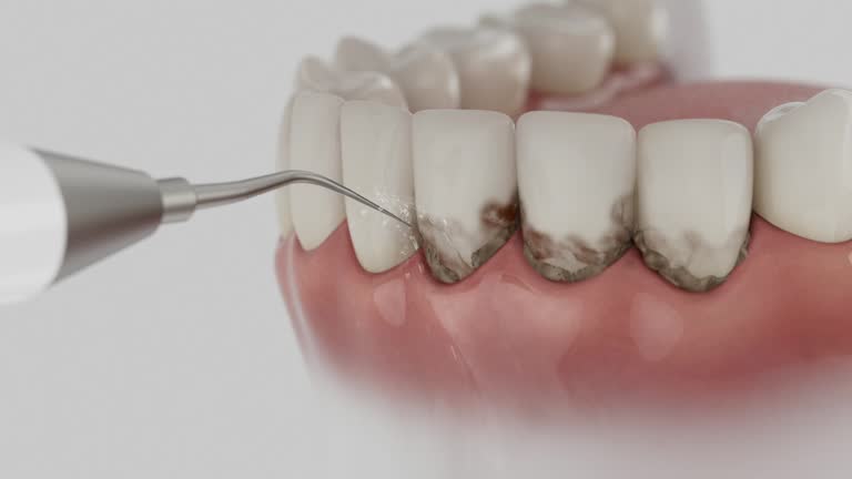 Trusted Dental Veneers service in Baltimore, MD - Dentist Open Now